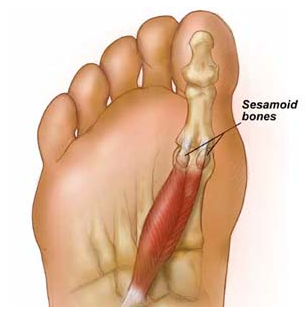 Big Toe Sesamoiditis