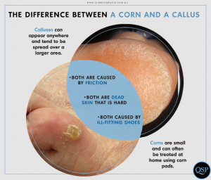 Is it a corn or callus?