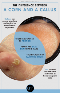 Difference between a corn and a callus infographic - Queen St Physio